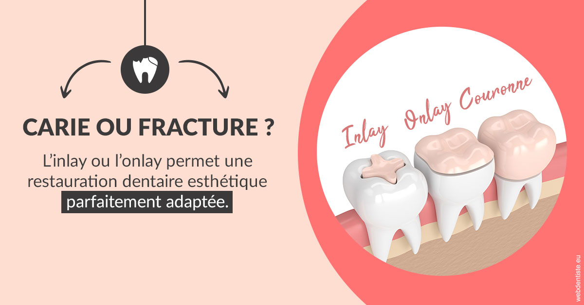 https://dr-leroy-gregory.chirurgiens-dentistes.fr/T2 2023 - Carie ou fracture 2