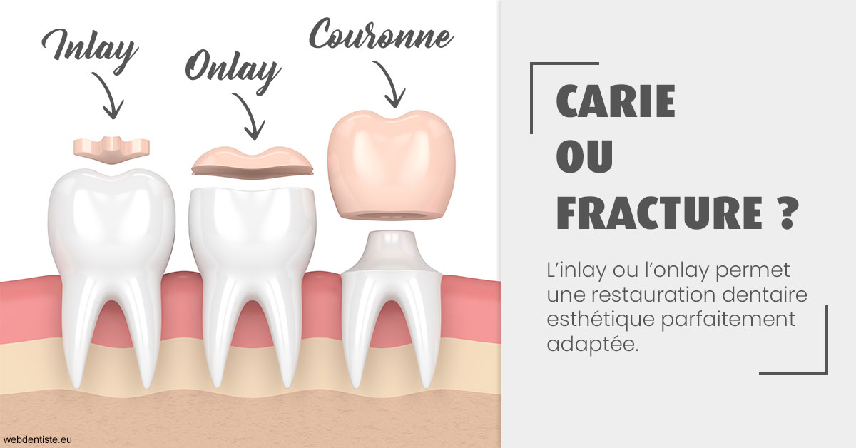 https://dr-leroy-gregory.chirurgiens-dentistes.fr/T2 2023 - Carie ou fracture 1