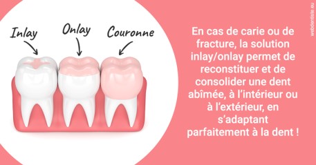 https://dr-leroy-gregory.chirurgiens-dentistes.fr/L'INLAY ou l'ONLAY 2